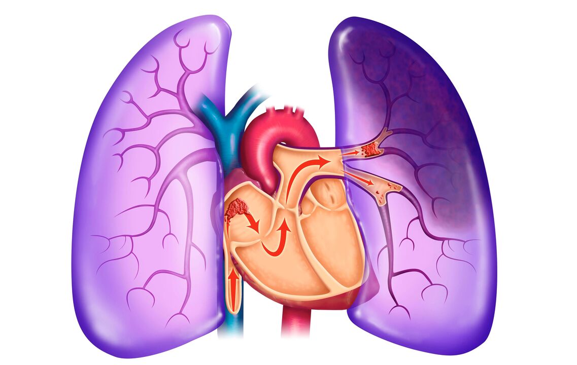 hipertensão pulmonar